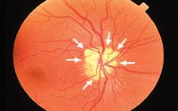 Optic Disc Drusen Eyewiki