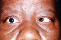 Sixth nerve palsy. Shown here is an impairment of abduction of the right eye on right gaze.