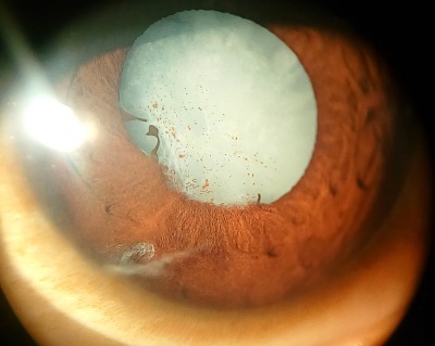 Traumatic Cataract