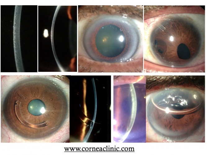 Fogla Slit Lamp Pics.jpg