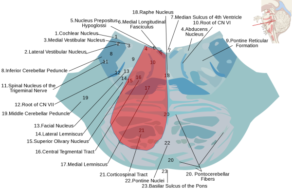 Diagram of lower pons, showing possibly infarcted region in red in Foville syndrome