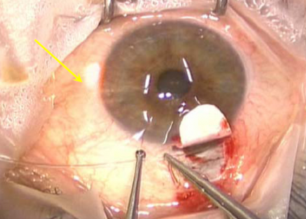 Figure 13: Withdrawing microcatheter with prolene attached back through Schlemm's canal