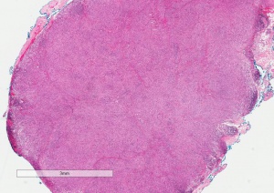 Fibrous Histiocytoma H&E 1.0x.jpg