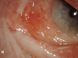 Conjunctival Amyloidosis.jpg