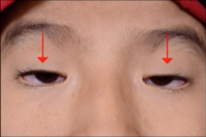 Ptosis in blepharophimosis.png