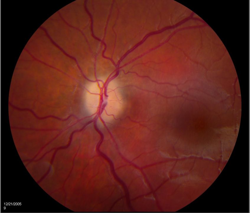 Resolved Papilledema (post shunt)