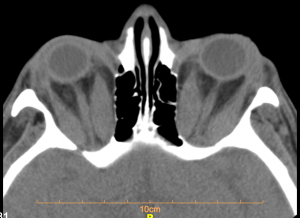 Dysthyroid Optic Neuropathy Eyewiki