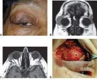 A, Right upper eyelid ptosis and fullness with a palpable mass beneath the orbital rim. B, Coronal MRI demonstrating right lacrimal gland enlargement with infiltration of anterior orbital tissues. C, Axial MRI showing characteristic molding of the lesion to adjacent structures. D, Incisional biopsy of the abnormal infiltration of the lacrimal gland reveals orbital lymphoma (arrow).