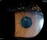 Fuchs Uveitis Syndrome