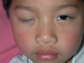 Figure 5. 4-year-old male with severe blepharoptosis of the right upper eyelid with a Marcus Gunn wink before and jaw movement. Photo urtesy of Rona Z. Silkiss, MD, FACS