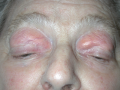 Figure 8. 85-year-old female with severe bilateral blepharoptosis before and after frontalis sling surgery. Photo courtesy of Rona Z. Silkiss, MD, FACS