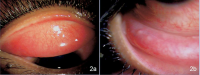 a, Slit-lamp biomicroscopy of the conjunctiva of patient no. 6 showing diffuse conjunctival congestion with papillary changes. b, Conjunctiva of patient no. 8 shows conjunctival congestion with follicles.