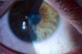 Mild herpes simplex stromal keratitis (Courtesy of Christopher J. Rapuano, MD)