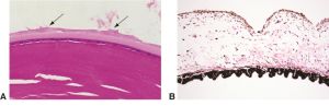 Pseudoexfoliation syndrome pathology