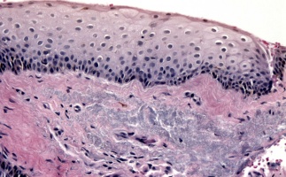 H&E Stain with subepithelial degeneration, photo courtesy of Dr.Nora Laver