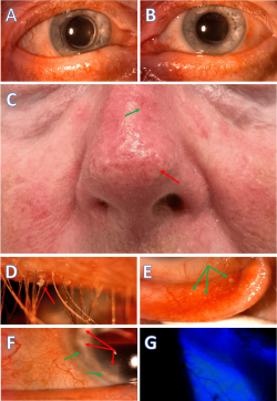 Cutaneous and Ocular Manifestations in a Rosacea Patient: A and B: The eyelid margins are rounded, notched, thickened, and exhibit telangiectasia. C: Phymatous rosacea presents on the nose (rhinophyma) and cheeks, marked by skin thickening, irregular nodular surface, telangiectasia (green arrow), fibrosis, and increased sebaceous gland volume (red arrow). D: Anterior blepharitis with waxy collarettes (red arrow) at the eyelash base. E: Conjunctival concretions (green arrows) on the palpebral conjunctiva indicate chronic inflammation. F: Abnormal blood vessel ingrowth (green arrows) and peripheral corneal scarring (red arrows), suggesting previous marginal keratitis episodes. G: Bulbar conjunctival staining in the lower areas adjacent to the eyelid margins. (Courtesy of J Khadamy)