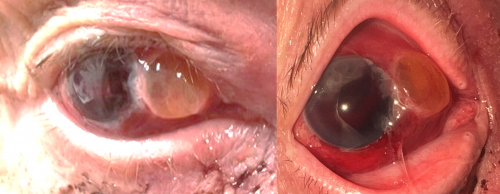 traumatic displacement of the crystalline lens (phacocele) beneath the conjunctiva