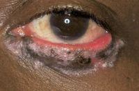 Photograph demonstrating that the involved eyelid skin displays alternating regions of hyperpigmentation and depigmentation. Eyelid margin thickening and madarosis are present.