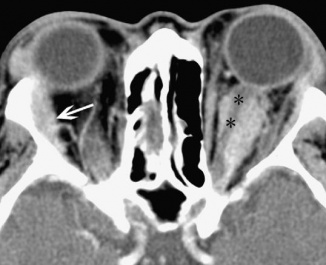 Figure 4: CT image of optic nerve involvement with sheath enhancement ("tramline" sign) (asterisks), white arrow showing right lacrimal gland enlargement. Courtesy of Z.X. Ding