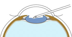 Phacoemulsification schematic view.png