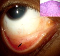 A 33-year-old woman with conjunctival granulomas. Arrow, biopsy site. The insert shows the conjunctival biopsy that revealed nonnecrotizing granuloma.