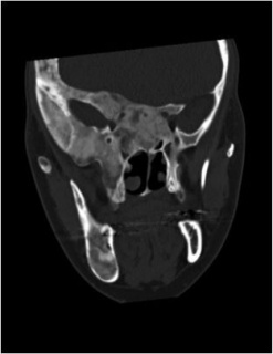 Figure 2. Craniofacial fibrous dysplasia.