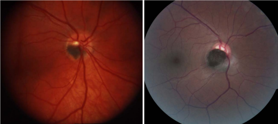 Optic Disk Melanocytoma and Optical Coherence Tomography Angiography ...