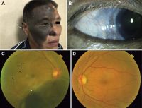 A 55-year-old man with uveal melanoma (UM) combined with oculocutaneous melanosis (OCM) who had the skin pigmentation in his right forehead, ear, cheeks, nose, eyelid, and skin folds (white arrow). B, Right eye with black conjunctival and episcleral pigmentation (white arrow). C, Fundus examination revealed a large pigmented mushroom-shaped choroidal melanoma with peripheral exudative retinal detachment (white arrow). The right fundus was dark (dark arrows) in color in comparison with the normal left eye (D). D, The normal left fundus is in orange color.