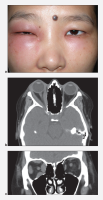 Idiopathic orbital inflammation (orbital myositis). a. Right proptosis, lid edema and erythema, mechanical strabismus, and ptosis. b, c. Axial and coronal CT images demonstrate enlargement of all extraocular muscles in the right orbit.