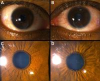 Fuchs Uveitis Syndrome - A 36-year-old man presented with asymptomatic uveitis in the left eye. The right eye was normal (A, C) The left eye (B, D)  had 1+ cell in the anterior chamber, small stellate keratic precipitates, and mild atrophy of the iris, and a posterior subcapsular cataract. Small pupillary nodules became evident after cessation of the corticosteroid eye drops.