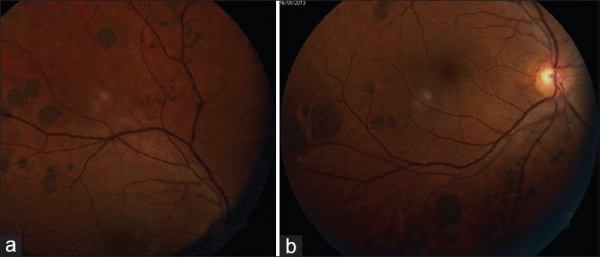 Congenital Hypertrophy of the Retinal Pigment Epithelium - EyeWiki