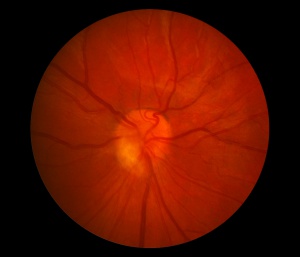 Ocular Toxocariasis. Provided by Ausra Selvadurai MD, Ross Eye Institute.jpg