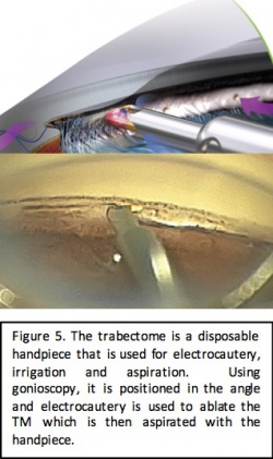 Trabectome fig 5.jpg