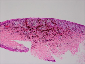 Fig. 1B - conj combined nevus path 1.jpg