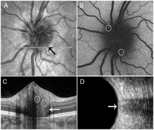 Infrared image (a) showing a ring (arrow) temporal to the optic disc, correlating with the exact location of the peripapillary hyperreflective ovoid-like mass structures (PHOMS) edge shown on enhanced depth imaging optical coherence tomography (EDI-OCT) in (c) (arrow). The PHOMS contains small hyperautofluorescent spots seen on fundus autofluorescence (b, encircled), and hyperreflective spots on the infrared images (c, encircled). d Ultrasound B-scan showing a hyperechogenic structure (arrow) at the optic nerve head, correlating with the PHOMS seen on EDI-OCT.