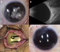 Case 3. A 3-year-old boy with a “cloud” in this eye was found to have an iris mass with aqueous seeding (A). By clinical examination and ultrasonography (B), the posterior segment was normal. The iris tumor (A) was sampled by FNAB, demonstrating retinoblastoma. Treatment with chemotherapy and plaque radiotherapy (C) yielded complete resolution of tumor to a calcified scar (D) in the inferotemporal angle.