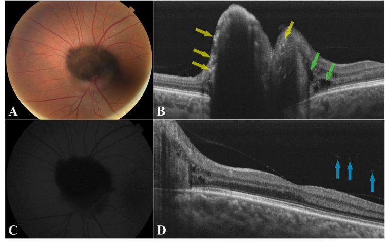 Optic Disk Melanocytoma And Optical Coherence Tomography Angiography Oct A Eyewiki 6917