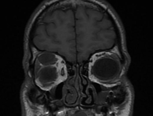 Orbital Neurofibroma - MRI.JPG