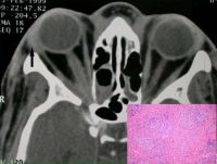 A 34-year-old woman with bilateral lacrimal gland involvement. Arrow, biopsy site. The insert shows the lacrimal gland biopsy that revealed well-circumscribed noncaseating granulomas.