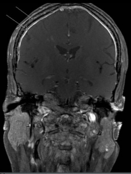 Dural and calvarial enhancement.jpg