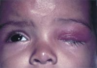 Conjunctivitis presenting within 30 days of birth is diagnosed as ophthalmia neonatorum.