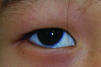 Epiblepharon. This condition commonly occurs in Asian patients on the lower eyelid.