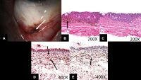 Images from a 71-year-old man. A, Slit-lamp photograph showing moderately pigmented lesions in the forniceal and adjacent palpebral and bulbar conjunctiva (arrow). B, Photomicrograph revealing densely pigmented spindled melanocytes containing copious intracytoplasmic pigment, consistent with blue nevus (arrow; stain, hematoxylin–eosin; original magnification, ×200). C, Photomicrograph demonstrating removal of melanin pigment with bleach and morphologically benign dendritic cells lacking prominent nucleoli (stain, permanganate bleach; original magnification, ×200). D, Photomicrograph demonstrating SOX10 staining (arrows) within the dendritic pigmented melanocytes (stain, SOX10 immunostain with red Chromagen; original magnification, ×400) E, Photomicrograph demonstrating CD68-positive melanophages (arrow) interspersed with the dendritic melanocytes (stain, CD68 immunostain with red Chromagen; original magnification, ×400).