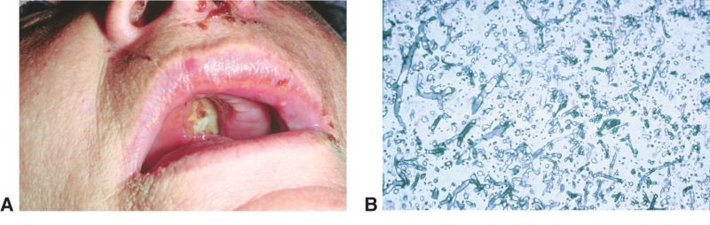 Patient with rhinocerebral mucormycosis with A. Mucormycosis eroding the hard palate and a confirmatory B, Biopsy specimen demonstrated typical nonseptate hyphae. Courtesy of Lanning B. Kline, MD, Available at AAO Website, last accessed Aug 15, 2022.