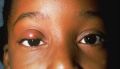 chalazion