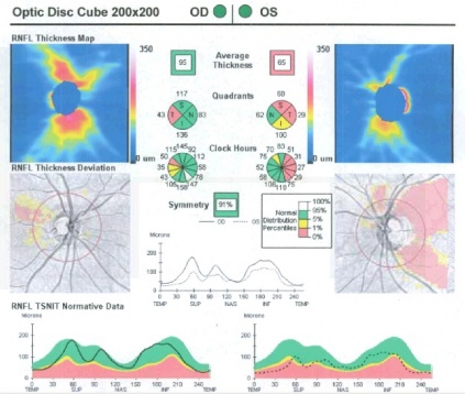 OCT NFL of the optic nerves 2.5 months post optic neuritis OD and 3.5 months post optic neuritis OS. 31yo women presented with OD count fingers vision and OS hand motion vision and at the time of this OCT, her vision had returned to 20/20 OU with color plates full OU. The left optic nerve is thinner than the right optic nerve. Sectoral atrophy OS is noted from 1 o'c clockwise to 5 o'c. Although the right optic nerve is close to normal value, there is thinning along the temporal fibers.