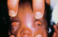 Gonococcal (Neisseria) conjunctivitis in an infant. Marked purulence is distinctive.