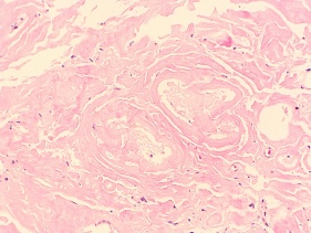 Conjunctival Amyloidosis H&E.JPG