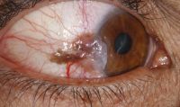 Slightly pigmented conjunctival SCC developed in a 44-year-old man with 3 years of known HIV