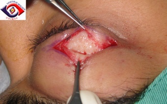 Figure 8: Showing whitish infiltration of the lacrimal gland on direct upper eyelid incision, Courtesy of Professor M Chua